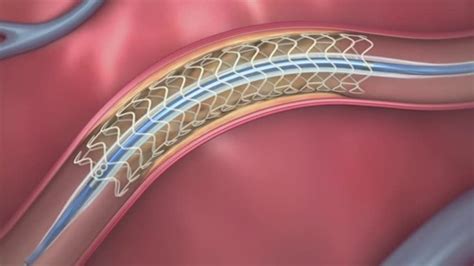 Dissolvable Heart Stent