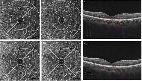 Frontiers Changes In Retinal Circulation And Choroidal Thickness In