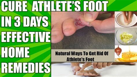 Best Home Remedies For Athlete S Foot Fungus How To Cure Athlete S Foot Fast Naturally At Home