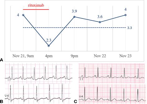 Frontiers Hypokalemia After Rituximab Administration In Steroid