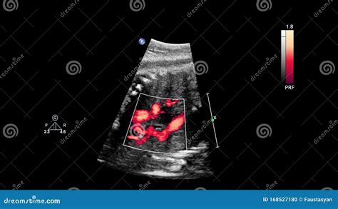 Ultrasound Scherm Met Foetale Echocardiografie Stock Foto Image Of