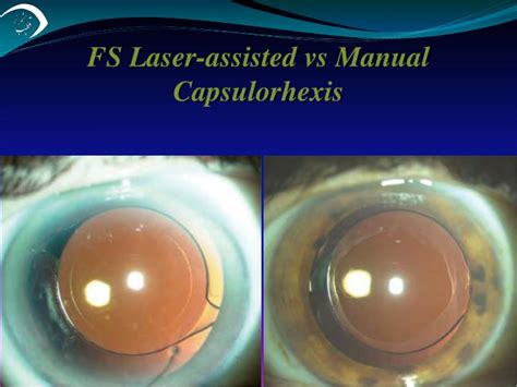 PPT Femtosecond Laser Assisted Cataract Surgery FLACS PowerPoint