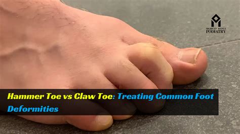 Hammer Toe Surgery And Recovery What To Expect