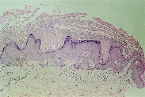 Kerinokeratosis Papulosa With A Type 2 Segmental Manifestation