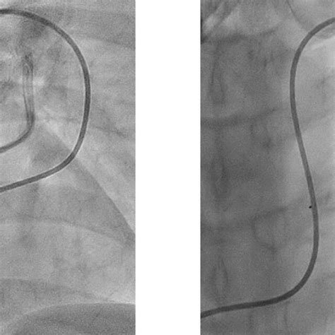 Selective Pulmonary Artery Angiography On Left Pulmonary Artery A A