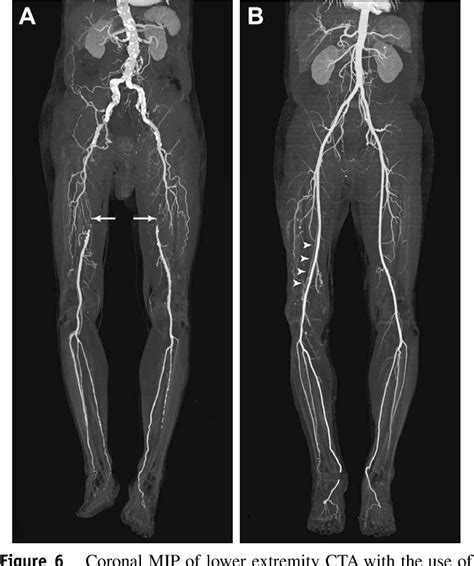 Lower Extremity Angiography