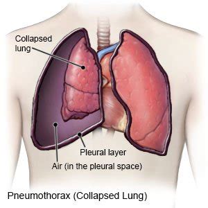 Traumatic Pneumothorax - What You Need to Know