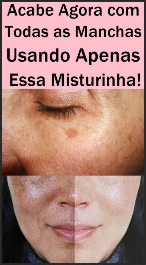 Dicas Caseiras Para Eliminar Melasmas No Rosto Manchas No Rosto