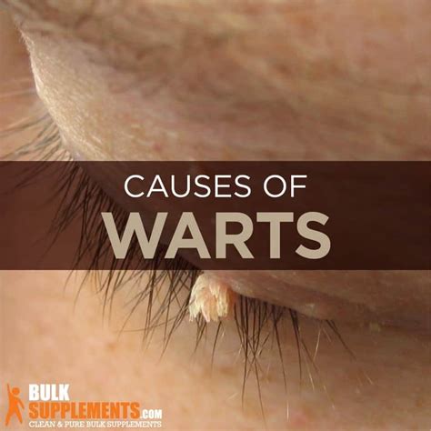 Warts: Causes, Symptoms, Characteristics & Treatment