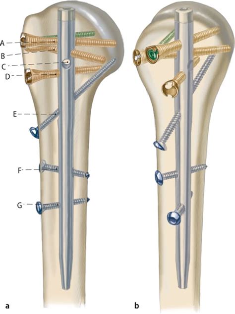 8 Proximal Humeral Nail Multiloc® Synthes Umkirch Germany A In