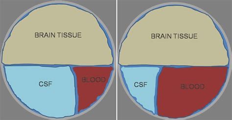 Intracranial Pressure High Intracranial Pressure Causes Symptoms