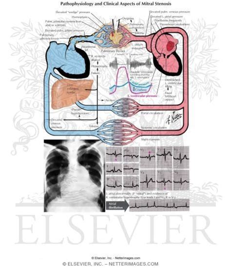 Pathophysiology Of Mitral Stenosis