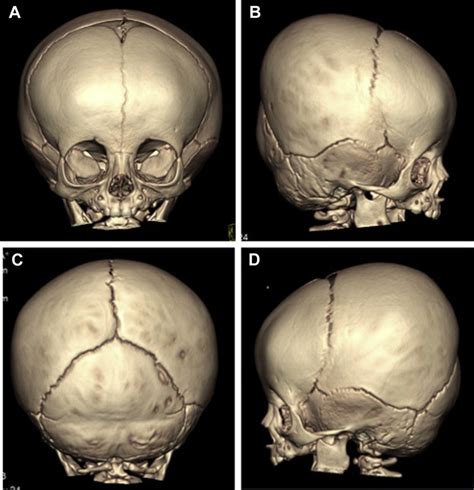 Bilateral Coronal Craniosynostosis