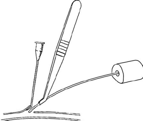 5 Vessel Cannulation Technique The Catheter Is Held In A Specialized