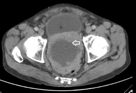 Contrast Enhanced Abdominal Computed Tomography Reveals A Hypodense Download Scientific Diagram