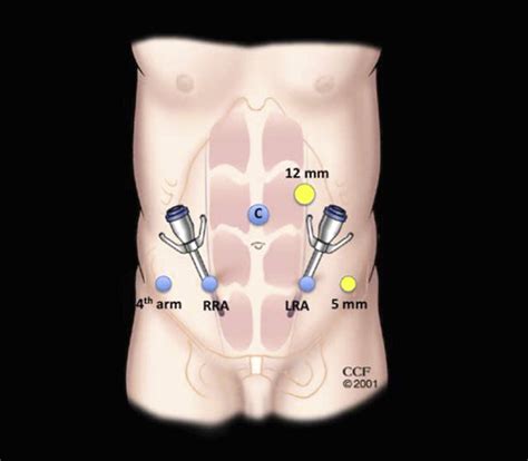 Robotic And Laparoscopic High Extended Pelvic Lymph Node Dissection During Radical Cystectomy