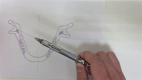 Мандибулярная анестезия - YouTube