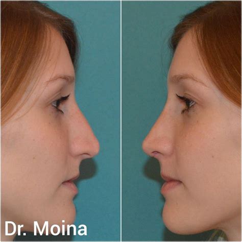 Pin de Rinoplastia Dr Moina en Rinoplastia Antes y Después Rinoplastia