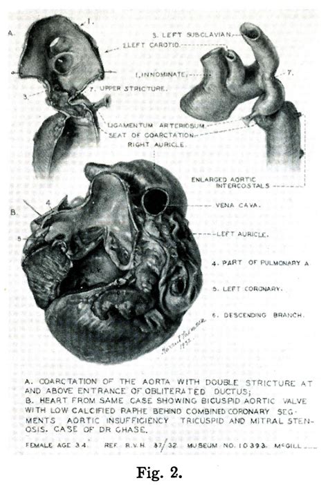 76 Coarctation Of Aorta Maude Abbott Medical Museum Mcgill University