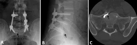 Anteroposterior A And Lateral B Radiographs Of The Lumbar Spine