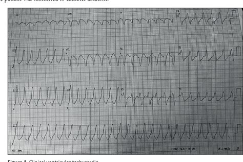 Figure 1 From Relationship Of Arrhythmogenic Substrate And Frequent