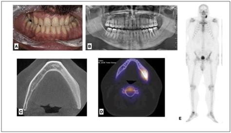 Medicina Free Full Text Chronic Diffuse Sclerosing Osteomyelitis Of