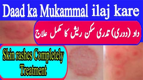 Daad Ka Mukammal Ilaj Kare Skin Rashes Completely Treatment Pak