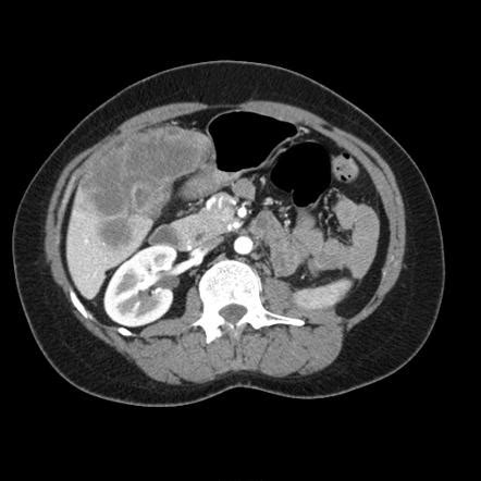 Gallbladder Adenocarcinoma Radiology Case Radiopaedia Org