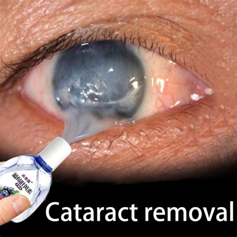 Eye drop Cataract Eye Drops Bright Eye Drops, Anti-Fatware, Blurred ...