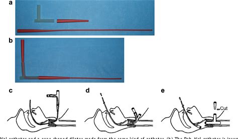 Figure From A New Technique For T Tube Insertion In Severe Subglottic