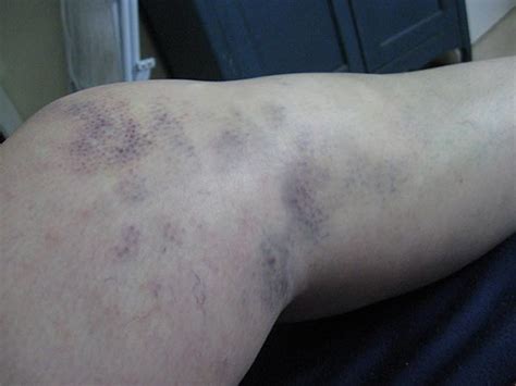 forstuvet knae behandling af forstuvede knae  praksis