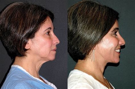 Deep Plane Facelift Before After Photos Dr Andrew Jacono Face