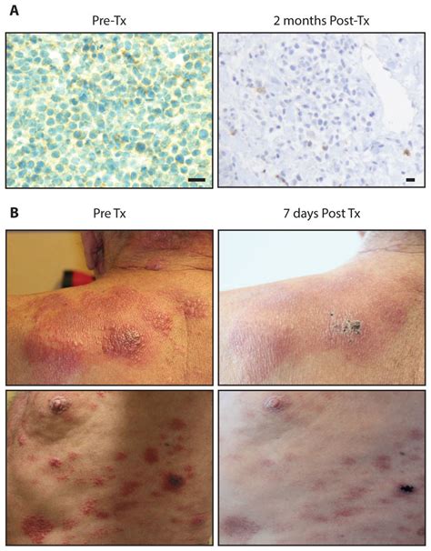 Brentuximab Vedotin Cleared CD30 Skin Lesions In Patient 5 A