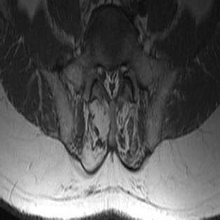 (PDF) Role of MRI and ultrasonography in evaluation of multifidus ...