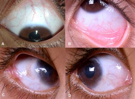 Simultaneous Surgical Management Of Unilateral Limbal Stem Cell