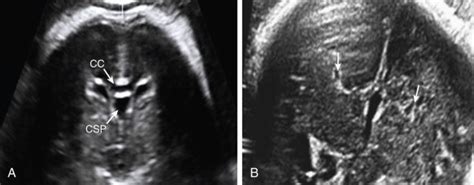 Corpus Callosum And Septum Pellucidum Anomalies Radiology Key