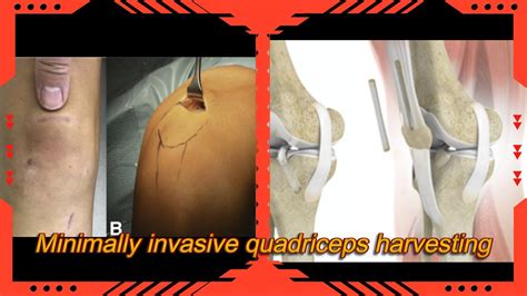 Revolutionizing Acl Reconstruction With Minimally Invasive Quadriceps