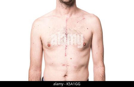 Some Scar from open heart surgery in studio Stock Photo - Alamy