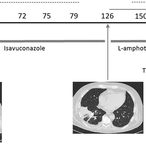 Figure Evolution Of Fungal Biomarkers Computed Tomography Chest