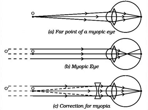 An Illustrated Explanation Of Myopia Understanding The Ray Diagram