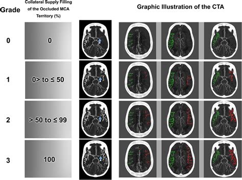 Use Of Thick Maximum‐intensity Projection Brain Computed Tomography Angiography For Evaluation