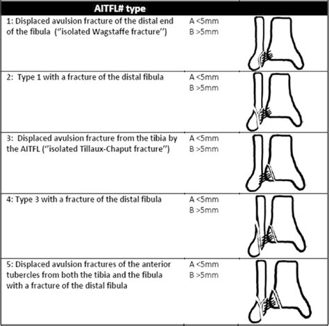 Distal Fibula Fracture Classification