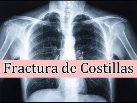 Fractura De Costilla Indicaciones Rehabilitacion Fisica YouTube