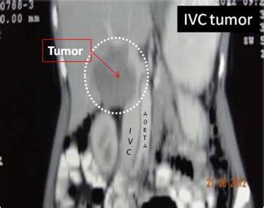 Spiral CT scan of the abdomen showing the tumor adjacent to the liver ...