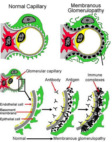 Membranous Glomerulopathy Causes Symptoms Diagnosis Treatment