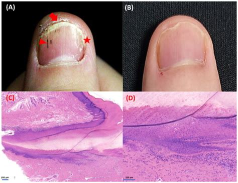 Full Article Alleviation Of Isolated Nail Lichen Planus By The JAK1 2