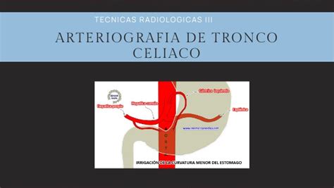 ARTERIOGRAFIA DE TRONCO CELIACO