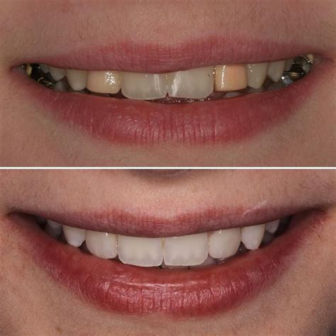 Jeffrey R Shapiro Dds Pc On Instagram Whitening And Ceramic Crowns