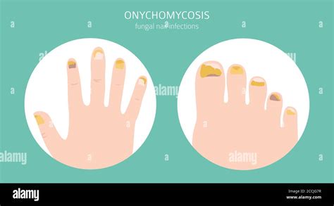 Nail Diseases Onychomycosis Nail Fungal Infection Causes Treatment