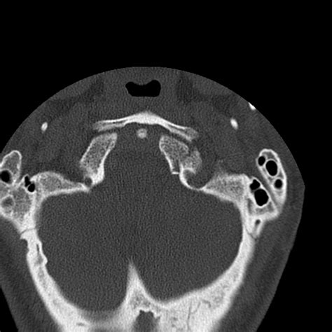 Occipital condyle fracture (Radiopaedia 31755-32691 Axial bone window) - NC Commons